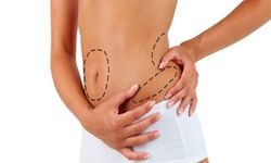 Liposuction Nedir ve İşlemi Nasıl Gerçekleşir?